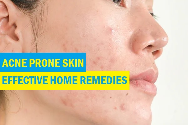 Effective Home Remedies for Acne-Prone Skin: Understanding and Curing